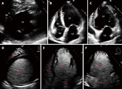 laminated thrombus